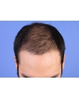 Before Hair Transplant&nbsp;Front